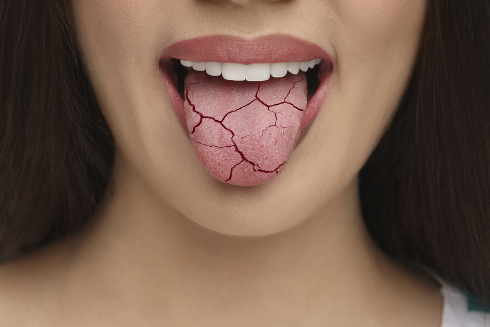 close up of woman with cracked and crumbling tongue to represent dry mouth