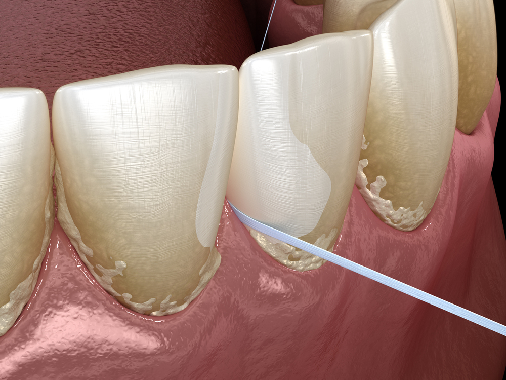 close up of floss cleaning tartar from between teeth and along gum line