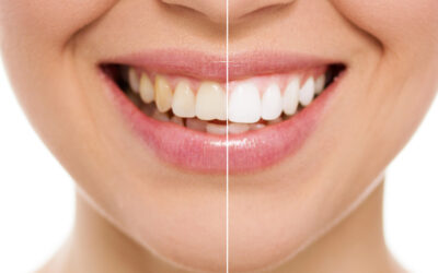 Professional Teeth Whitening: Why the Advantages Far Outweigh the Drawbacks