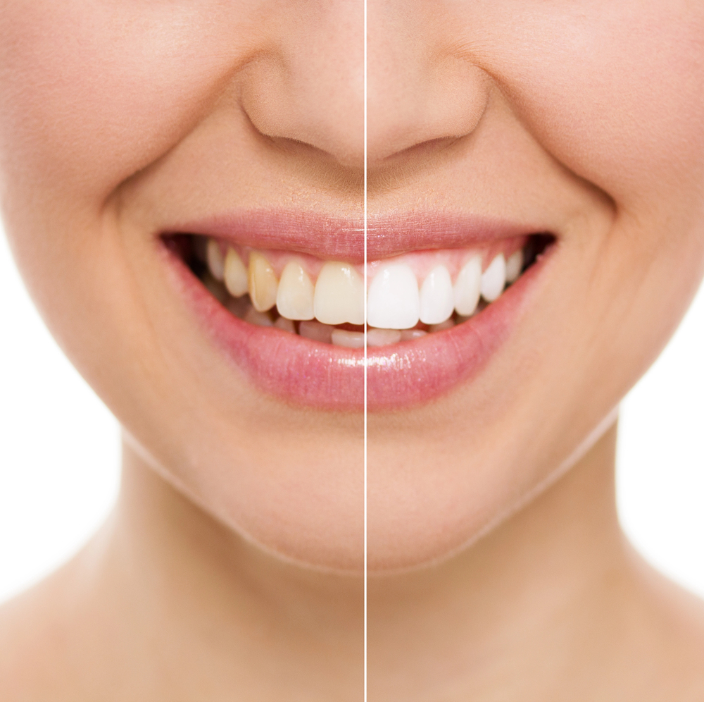 before and after teeth whitening