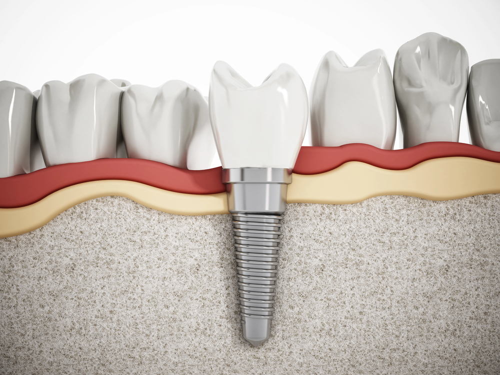 dental implant placed in bottom jaw