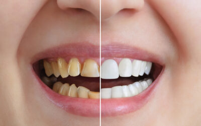 The Hidden Consequences of Misaligned Teeth: More Than Just a Cosmetic Concern